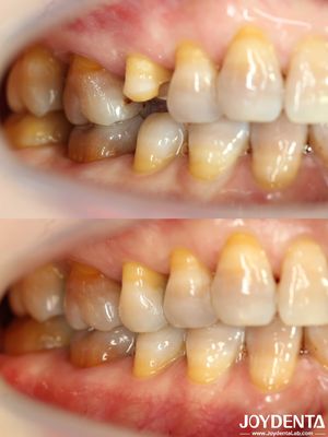 Personalizable Incremento Dental asequible Restaurador Preciso Adecuado para Dientes Dañados