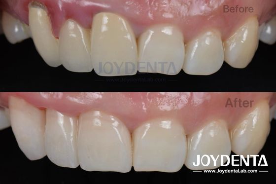 Procedimiento indoloro BOPT Técnica dental para la preparación precisa de los dientes