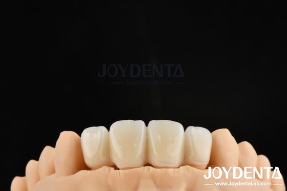 Técnica de preparación biológicamente orientada BOPT para una preparación dental precisa