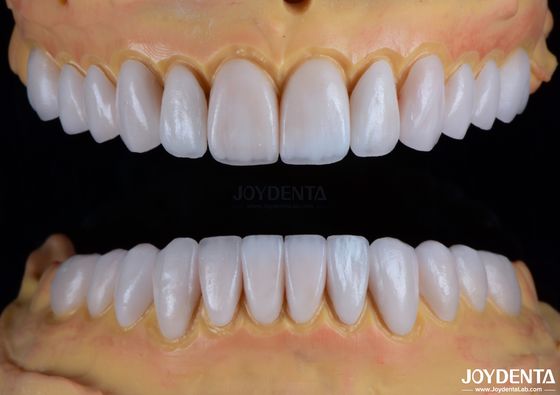 Carillas de porcelana Emax hechas a medida de textura lisa Restauración dental