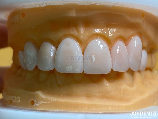 Carillas de aspecto natural de alta permeabilidad Carillas de porcelana Emax personalizadas