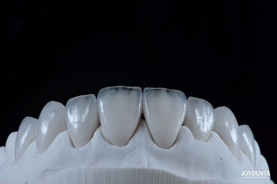 Vista natural de las carillas de porcelana Emax Confortable ajuste Ultra delgado carillas Emax
