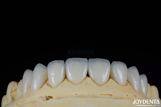 Superficie brillante Texturas de superficie feldspática Veneer de apariencia natural Veneer de porcelana