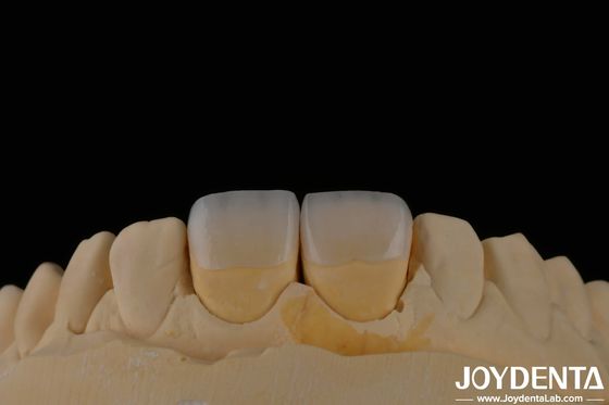 Dentista de larga duración Veneer feldspático color natural de los dientes apariencia translúcida