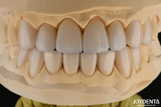 0.3-0.5mm de espesor de porcelana feldspática carilla de alta resistencia a la fractura mejorar su sonrisa
