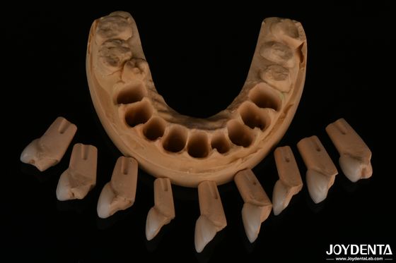 Venecedura dental feldspática de ajuste preciso muy natural con textura de superficie brillante