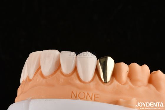 Ultra delgado IPS Emax Prensa carillas Cosméticas carillas de dientes para restauraciones anteriores y posteriores