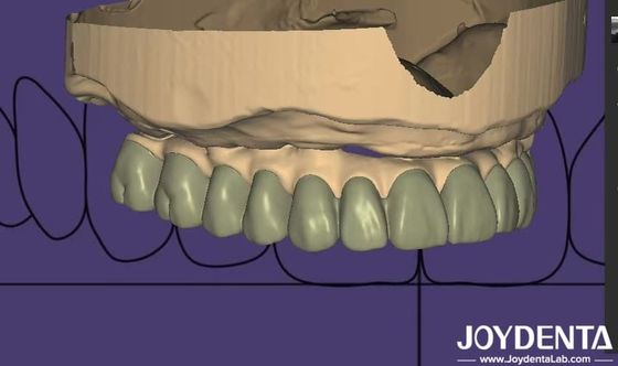 Diseño individualizado de diagnóstico digital de laboratorio de software de cera integración sin fisuras