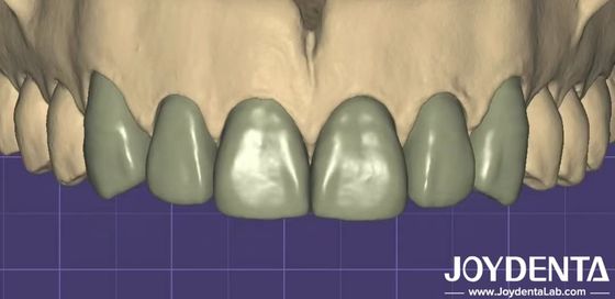Impresión en 3D Virtual Digital Wax Up Compatibilidad perfecta con otros programas dentales