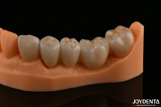 Restauraciones dentales de precisión Zirconia completa Alta resistencia a la flexión Color natural