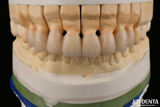 Coronas de zirconia de alta translucidez con capas Puentes Restauraciones dentales Aspecto realista
