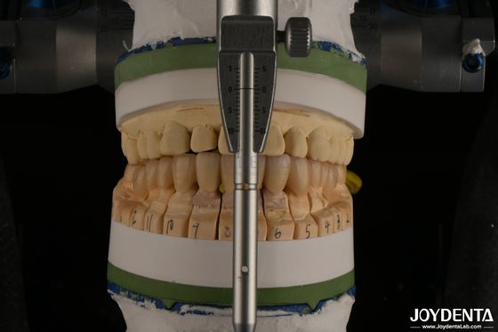 Alta estética Zirconia dental en capas de porcelana para restauraciones de implantes