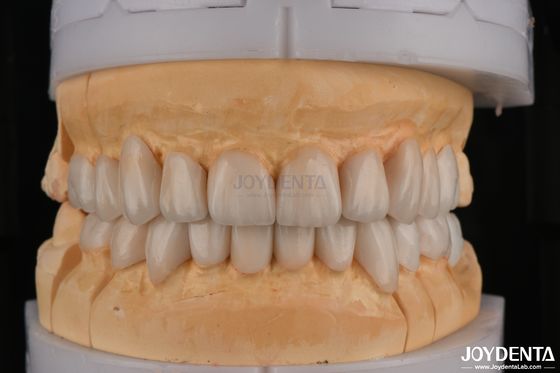 Zirconia con capas de alta translucidez para restauraciones dentales de contorno completo