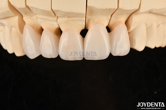 Coronas y puentes dentales de zirconia de capas altamente personalizables Solución duradera
