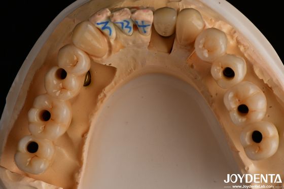 Alta translucidez de contorno completo de múltiples capas de zirconio de aspecto natural 1200 HV