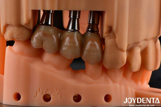 Solución dental de zirconia completa de alta resistencia flexional de múltiples capas Restauraciones de arco completo