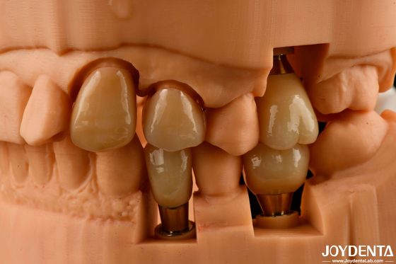 La corona y el puente de los implantes personalizables dan un aspecto natural con resultados duraderos