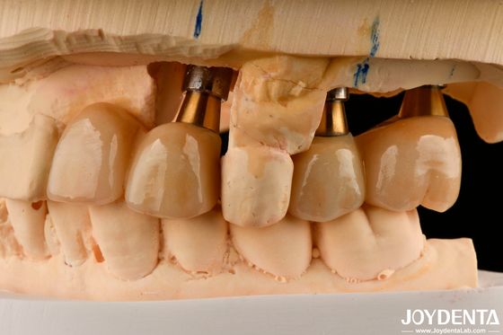 Restauración de los dientes faltantes Implante de corona y puente seguro para oral con ajuste preciso