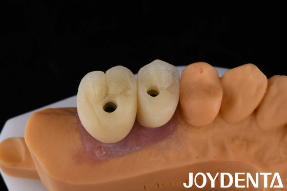 Implante de corona y puente de porcelana La solución definitiva para la restauración de los dientes perdidos