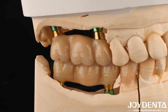 4.5 mm de altura pulido hexodental interno abutments implante dental de forma V tornillo retenido