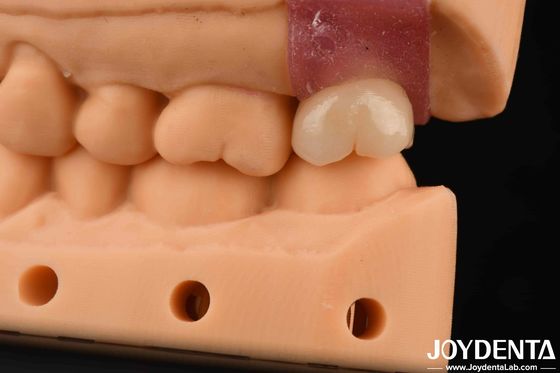 4.1mm V en forma de hilo abutments de titanio con conexión hex interna