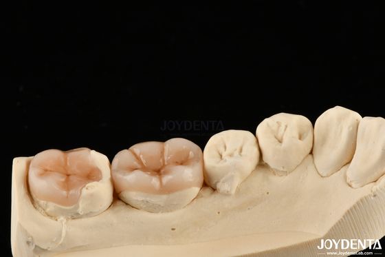 Restauración dental con apariencia natural