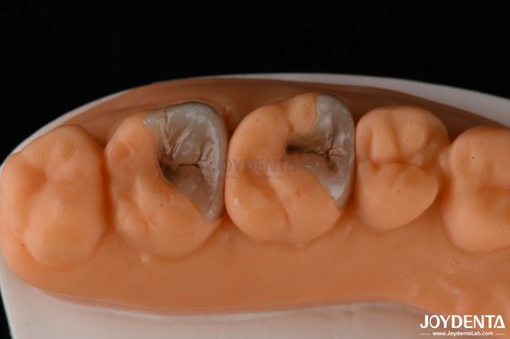 Inlays y onlays compuestos para la restauración dental
