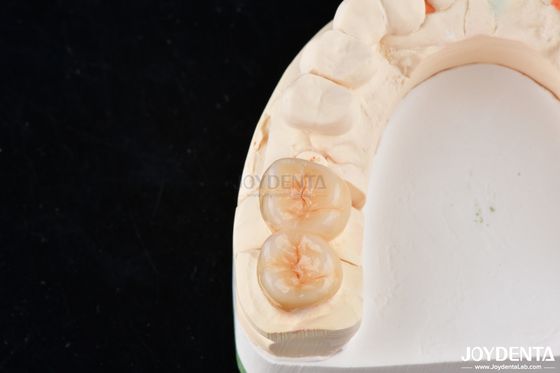 Enlaces y enlaces de zirconia dental de aspecto natural de alta estética y precisión