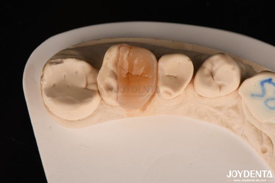Inlay de zirconio con cementación adhesiva para la restauración de dientes dañados