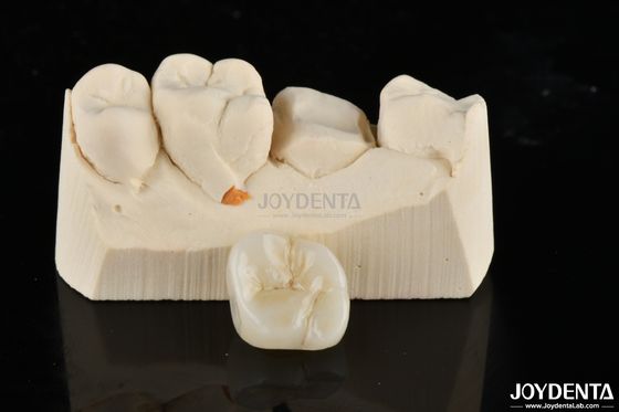 Inlays y onlays de zirconia restaurados a medida para un ajuste y una estética incomparables