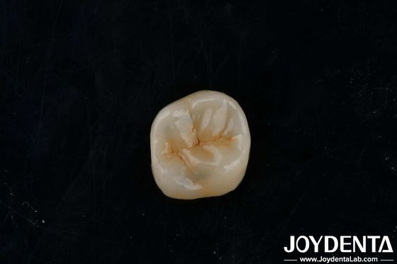 Adhesivos de zirconia personalizables con incrustaciones de alta translucidez para la restauración