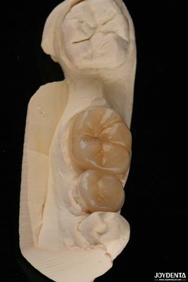 Enlaces dentales Emax y enlaces resistentes a las fracturas de 1,5 mm de baja translucidez