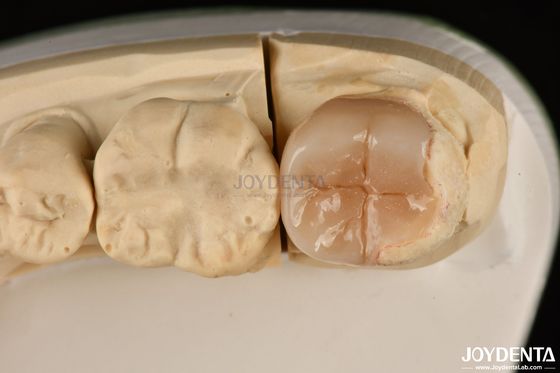 Fácil limpieza Emax Inlays y Onlays Hipoalergénicos Restauraciones dentales biocompatibles