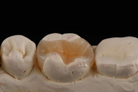 E Max Material Incrustado y Encrustado en Odontología Restauración Estética Duradera