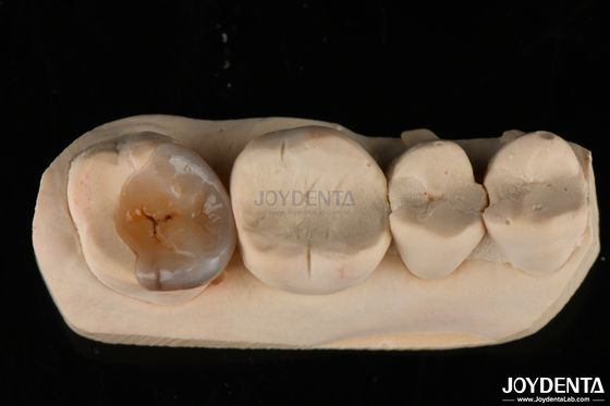 Enlaces y enlaces dentales personalizados de aspecto natural para la restauración dental