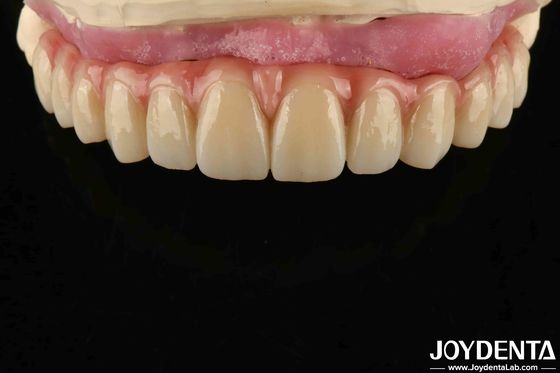 Confort Wear Titanio Malong Hybrid Puente Dental Diseño ajustable Peso ligero