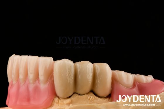 Prótesis de acero inoxidable Dentes postizas parciales Adjuntos de bolas de superficie pulida Adjuntos