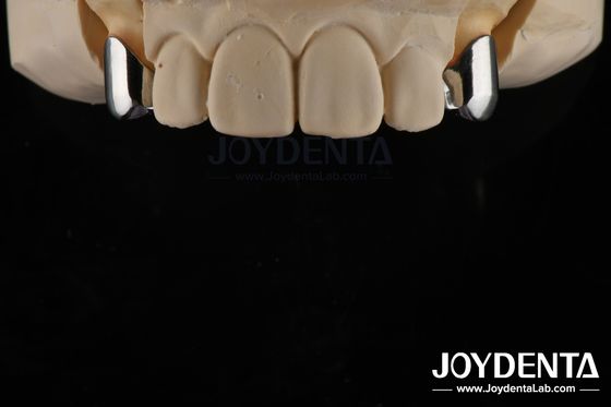 Prótesis extraíble de precisión Implantes dentales Apegos fáciles de limpiar