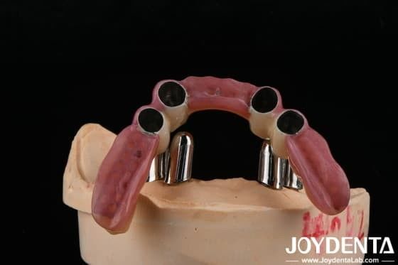 Precisión dental Apego apoya dentaduras parciales Restauración precisa