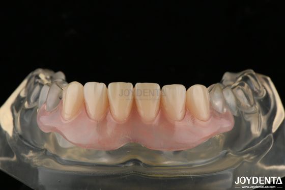 Dentadura Invisible Personalizada Terminada con Tecnología Avanzada de Disposiciones Dentarias