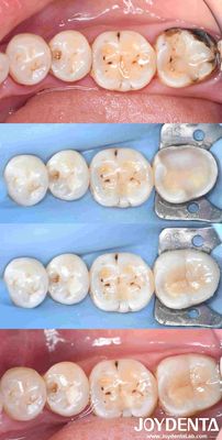 Restauración de incrustación de porcelana dental personalizable para la reparación de dientes perfectamente ajustados