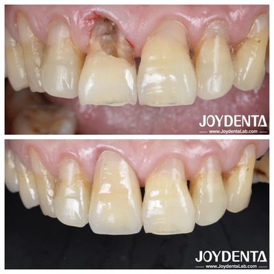 Dentes de superficie lisa con corona de zirconia para restauraciones posteriores y anteriores