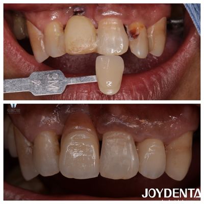 Fabricación dental de cerámica de zircónia de color natural Restauración de dientes