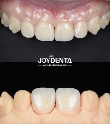 Puentes dentales de zirconia de superficie lisa y ligera para restauraciones con implantes
