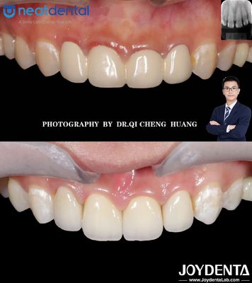Coronilla de zirconia de alta translucidez de múltiples capas para dientes anteriores y posteriores resistentes a las grietas