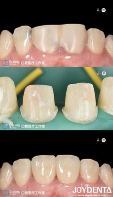 Dientes perfectamente ajustados Coronas dentales de zirconia con sistemas CAD CAM para fabricación de precisión