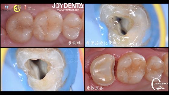 Durabilidad natural de apariencia dentaria incrustación de cerámica ajuste preciso alta compatibilidad