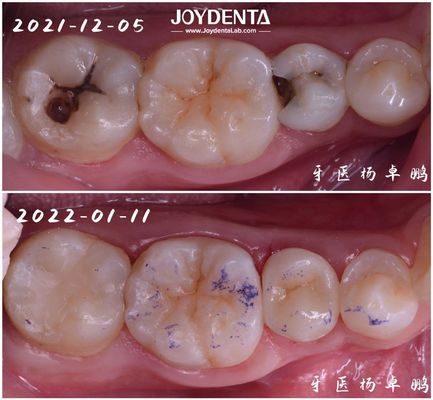 Restauración dental con incrustación de alta durabilidad para dientes dañados
