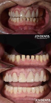 Forma natural Cosmética Odontología Carillas de porcelana, Dental Cosmética Carillas de porcelana