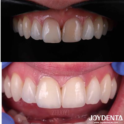 Carillas dentales de superficie lisa para dientes torcidos, carillas de porcelana cosmética personalizada